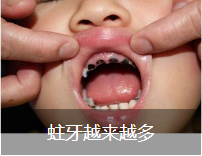 蛀牙越来越多
