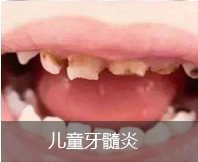 儿童牙髓炎