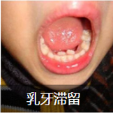 乳牙滞留