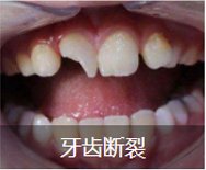 牙齿断裂