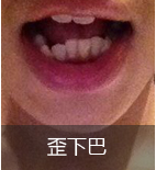 歪下巴