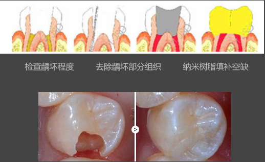 舒适补牙