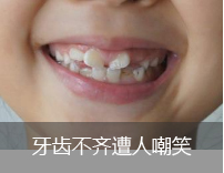 牙齿不齐遭人嘲笑