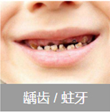 龋齿 / 蛀牙