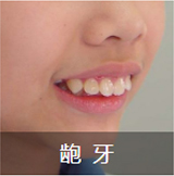 龅  牙